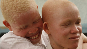 albinos